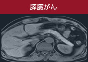 膵がんドック