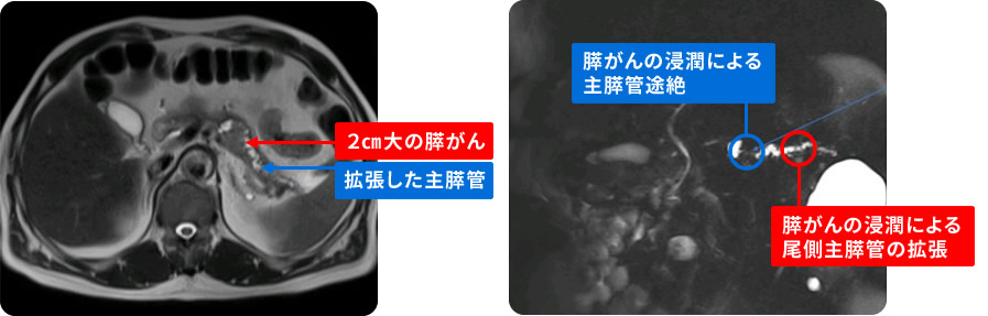 腹部MRI・MRCP検査で映し出された膵がんの症例