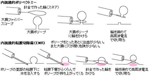 ポリープ